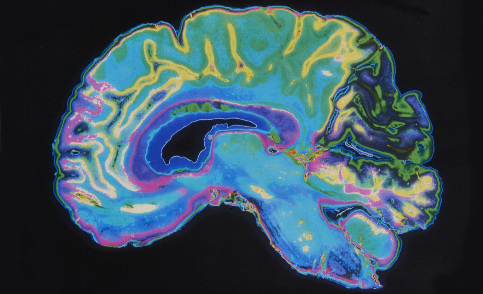 L'intelligenza artificiale ha imparato a identificare i primi sintomi della schizofrenia