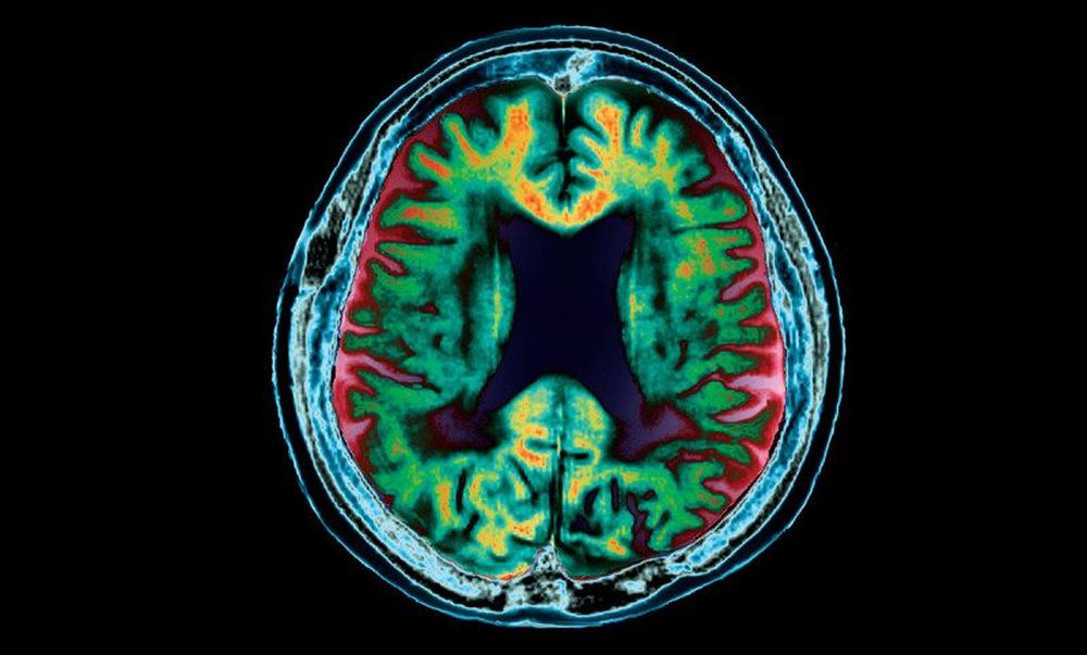 La maladie d'Alzheimer peut être contractée lors d'une transfusion de sang