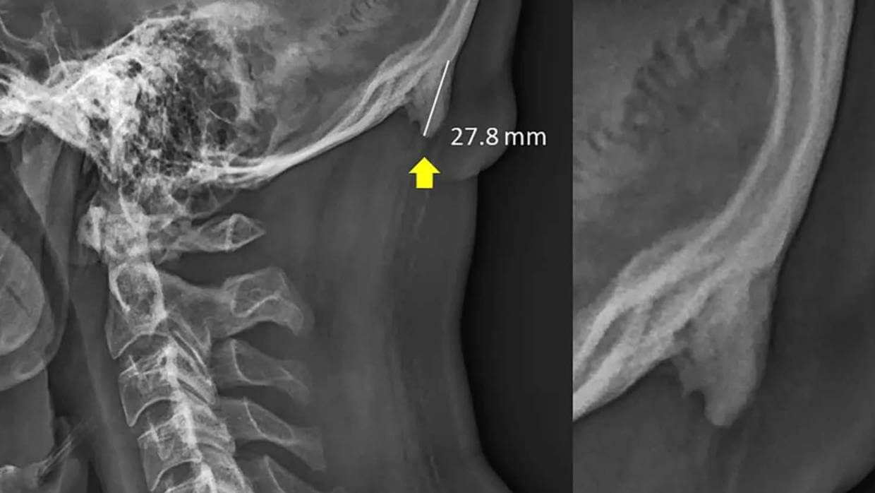 Scientists: Frequent use of smartphones leads to the growth of the horns. Literally