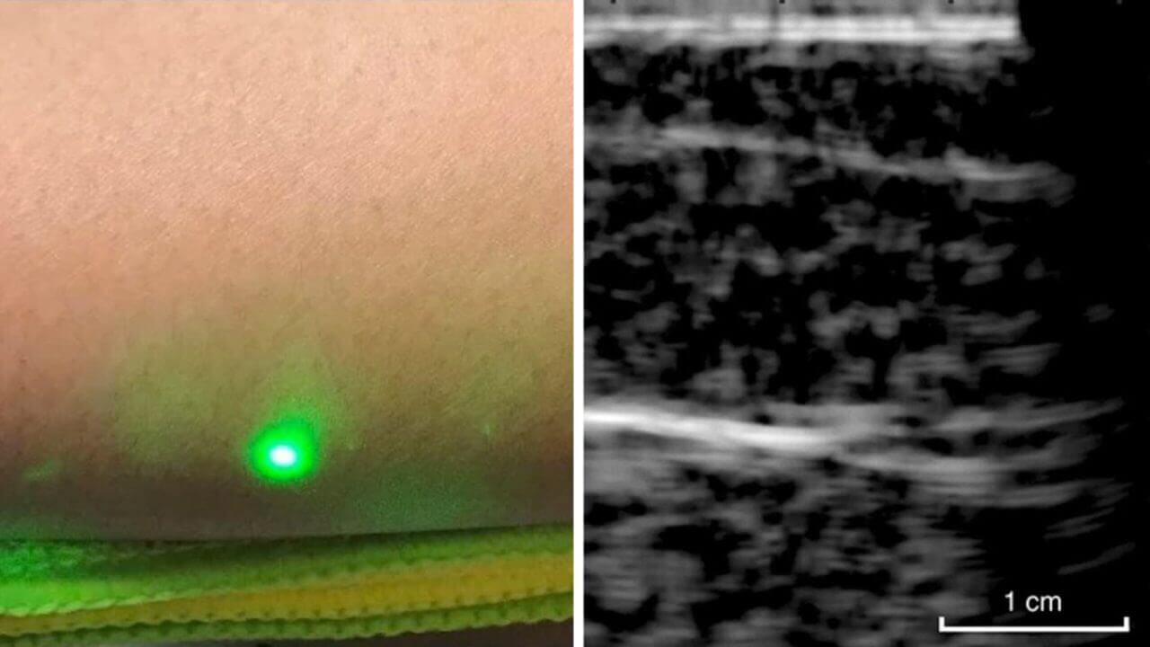 Apparatus for noncontact laser ultrasound for the first time tested on humans